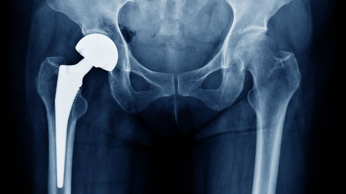Kunstgelenk fr Knie und Hfte? Das ist zu beachten