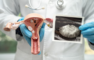 Neue medikamentöse Therapieoptionen in der Myombehandlung